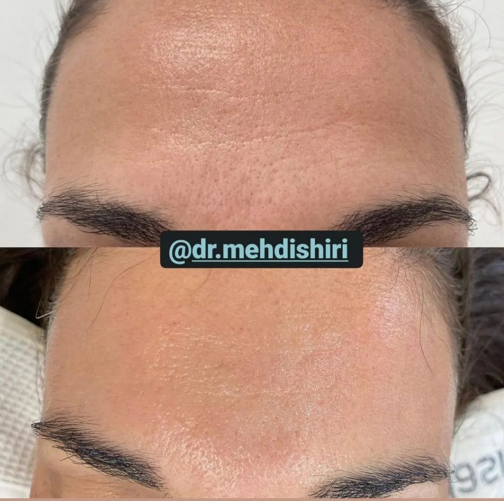 eyebrow and forehead lift