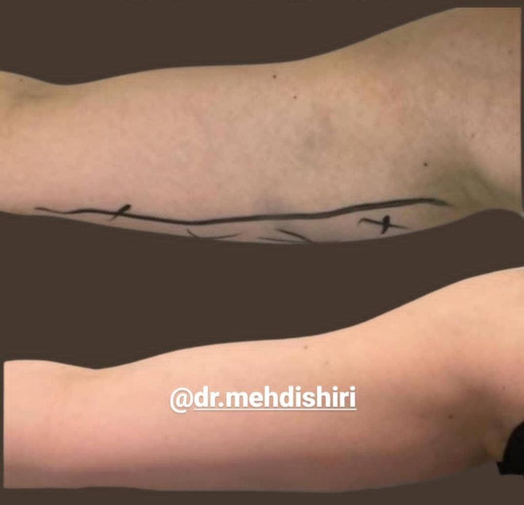 arm lift dr mehdi shiri