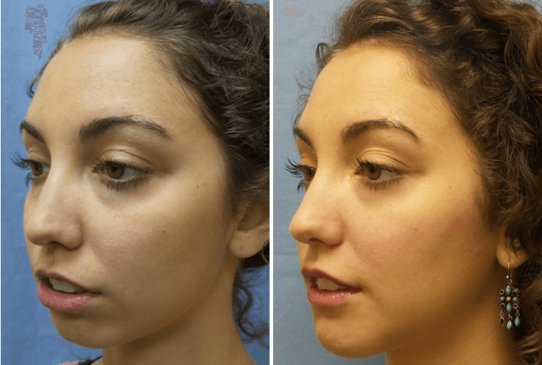 chin-augmentation-dr-mehdi-shiri