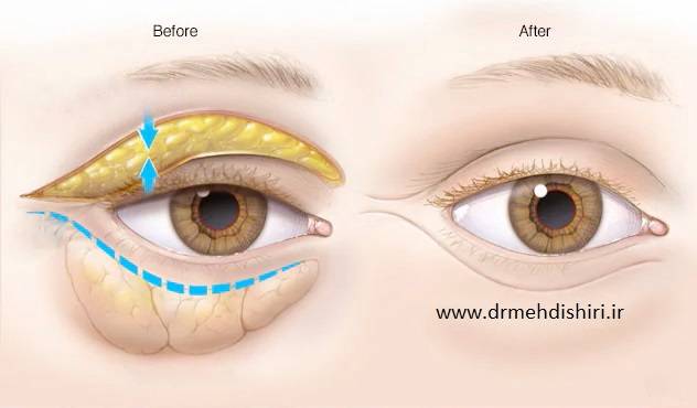 dr_mehdishiri-eyelidsurgery