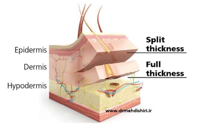 drmehdishiri-grafts