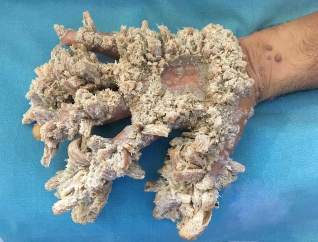 epidermodysplasia verruciformis