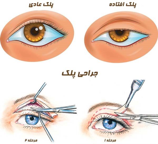 dr shiri ptosis surgery